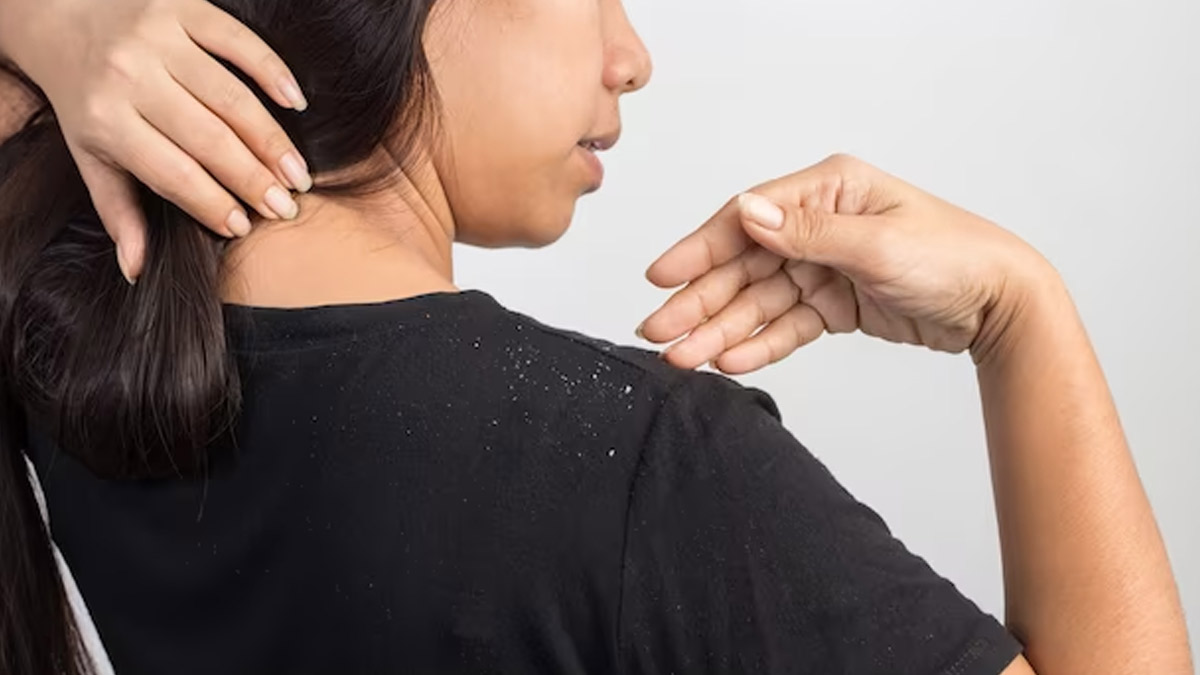 Is Dandruff Causing Itch And Flakes? Home Remedies To Get Rid Of It