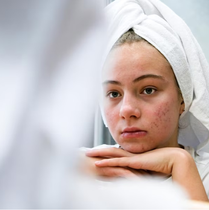 Skincare Tips To Reduce Humidity-Related Skin Problems | Onlymyhealth