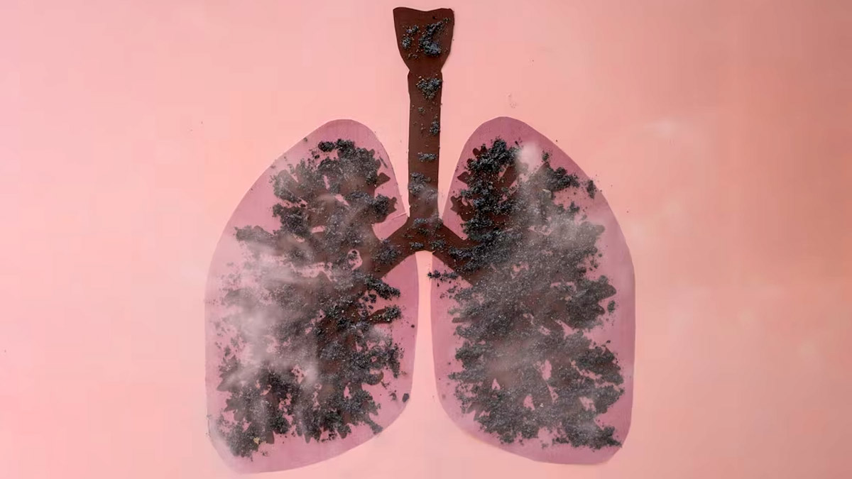 Pulmonary-Fibrosis