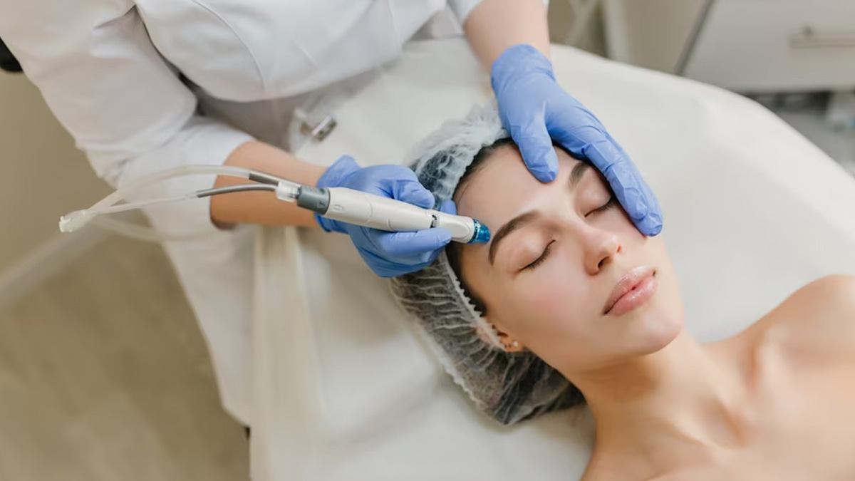 Microneedling