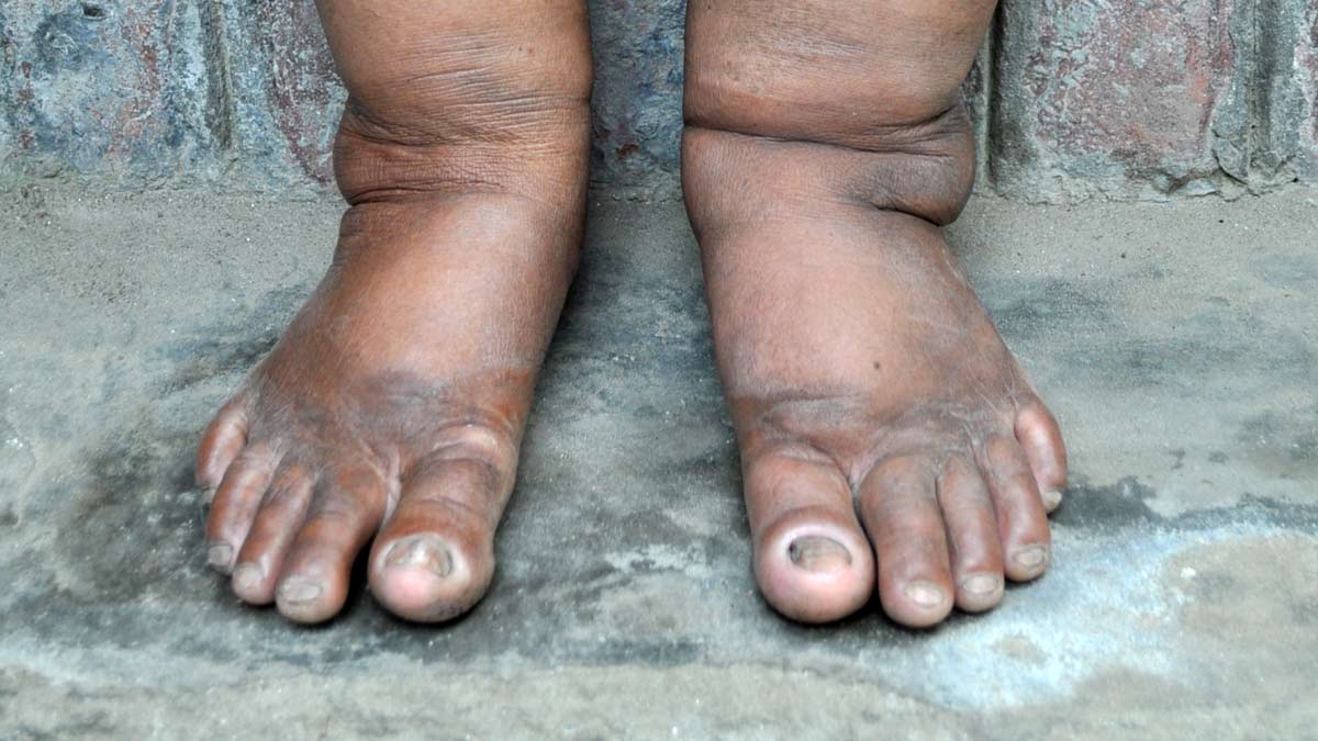 UP News: यूपी में फाइलेरिया से बचाव के लिए चलाया जा रहा अभियान, जानें इस बीमार से बचने के तरीके