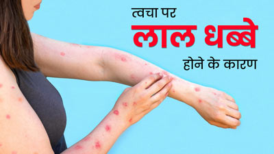 त्वचा पर लाल स्पॉट क्यों होते हैं? डॉक्टर से जानें इसके कारण 