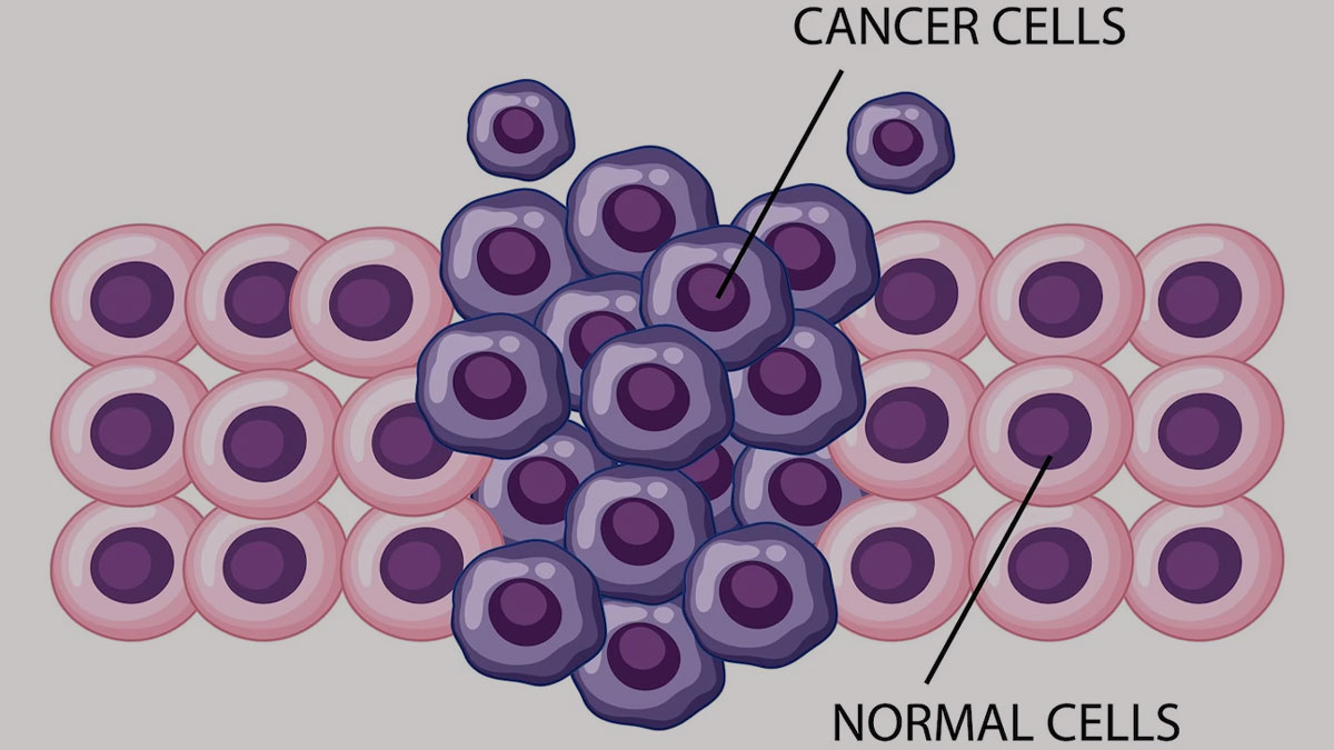 cancer cell spreads