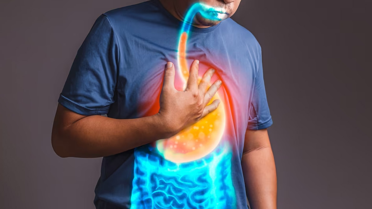 Acid-Reflux-Burning-sensation-in stomach