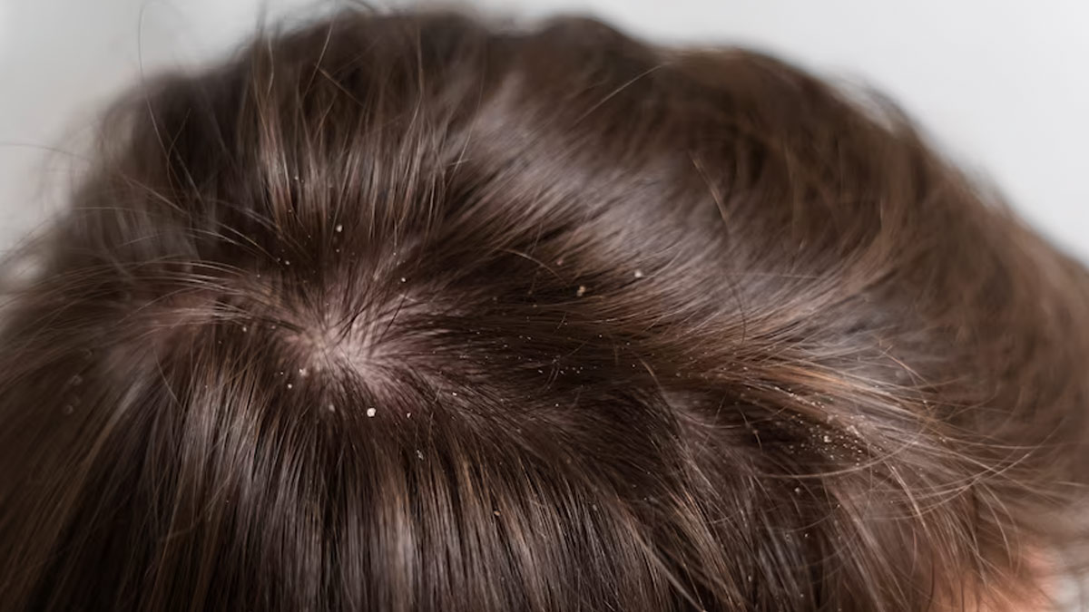 Here's How You Can Use Camphor To Get Of Stubborn Dandruff OnlyMyHealth