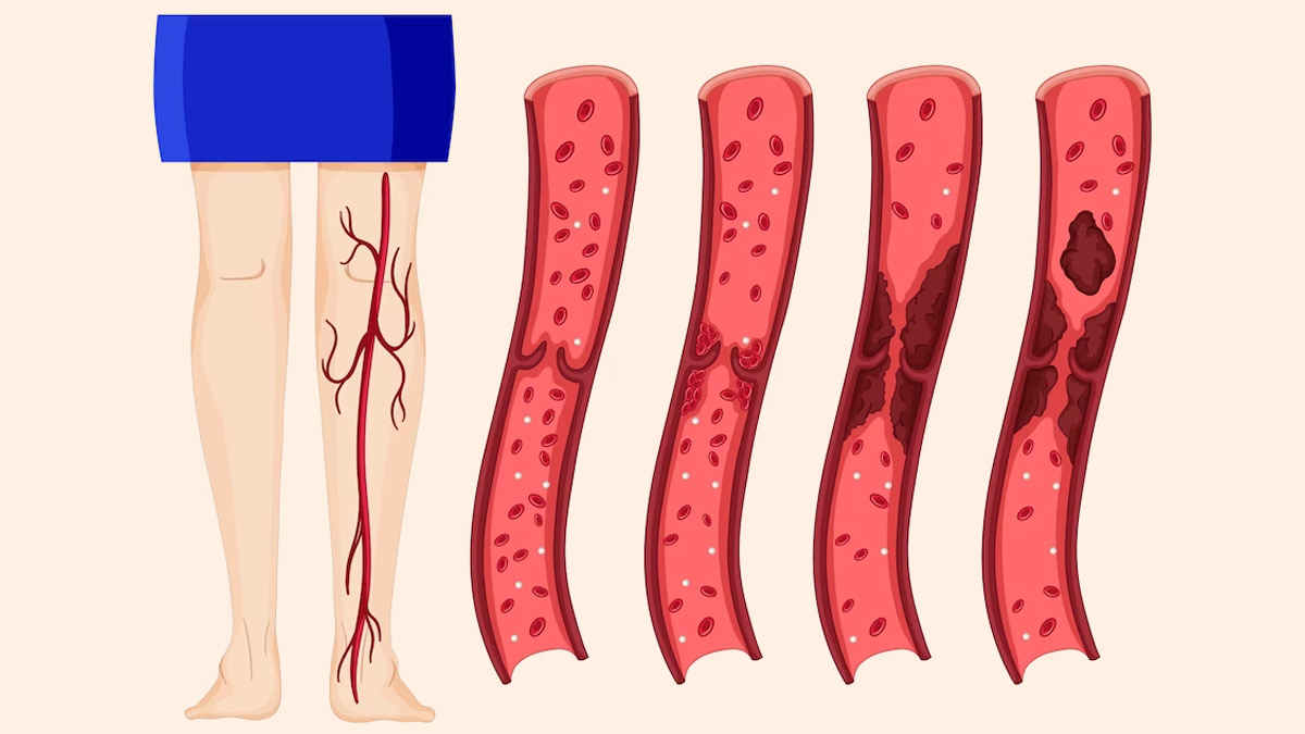 Deep-Vein-Thrombosis