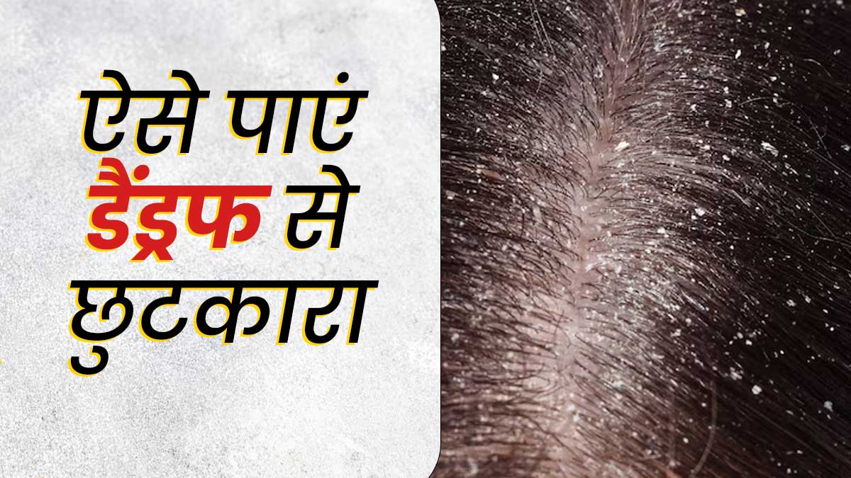 डैंड्रफ से छुटकारा पाने के ल‍िए इस तरह करें बालों की सफाई, दूर हो जाएगी रूसी और खुजली की समस्या