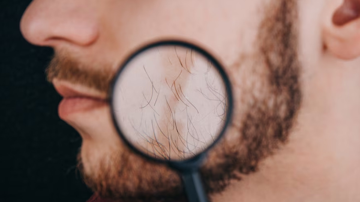 Beware Of Beard Dandruff Heres What Causes It And Ways To Get Rid Of The Skin Condition 