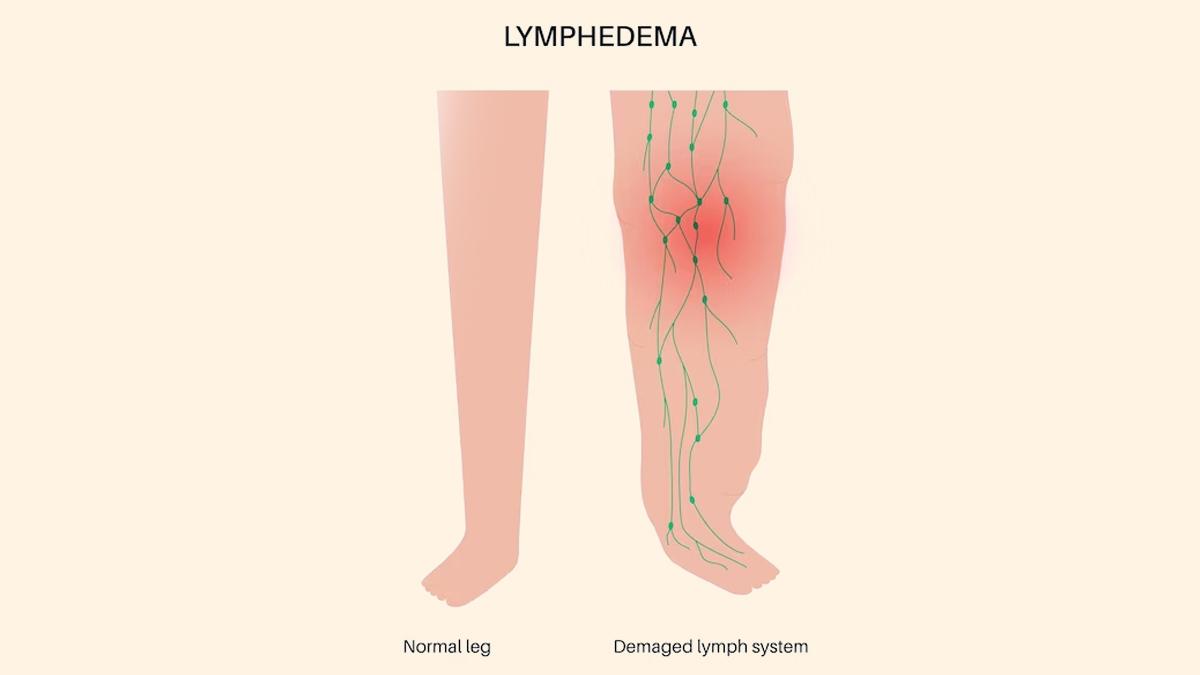 Lymphedema Category
