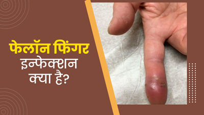 फेलॉन फ‍िंगर (फ‍िंगरट‍िप के मांस) इंफेक्‍शन क्‍या होता है? जानें इसके लक्षण, कारण और इलाज 