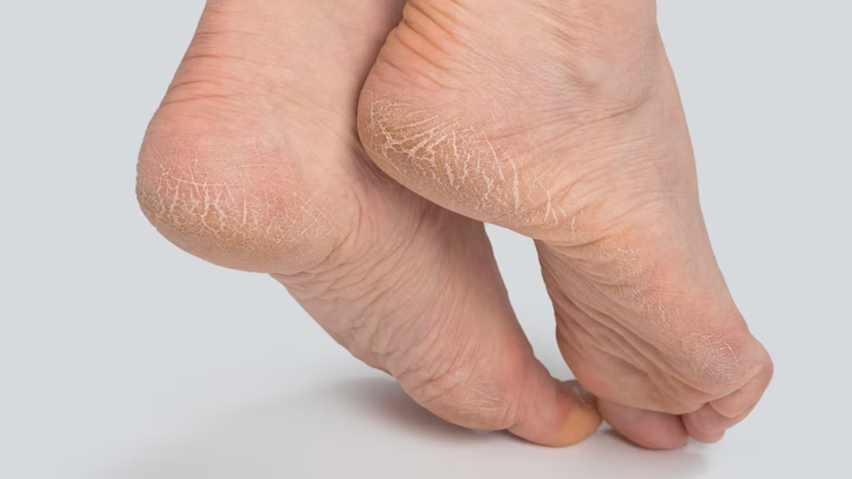 Effective Remedies for Dry Cracked Heels