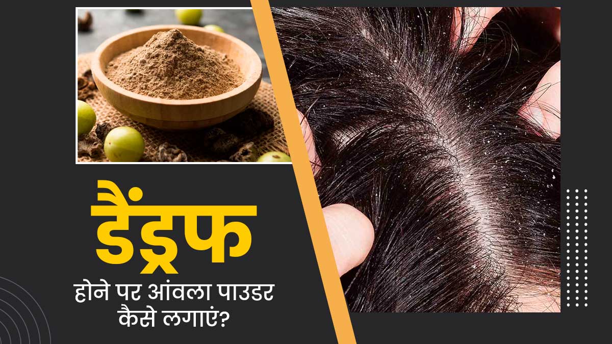 डैंड्रफ से परेशान हैं, तो इन तरीकों से करें आंवला पाउडर का इस्तेमाल, दूर हो जाएगी रूसी और खुजली