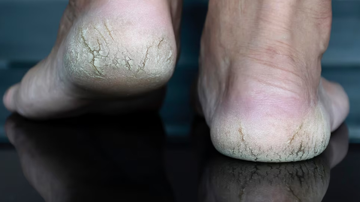 Do you suffer with Dry Skin? Cracked heels? - Podiatrist | Narellan |  Podiatry and Moore