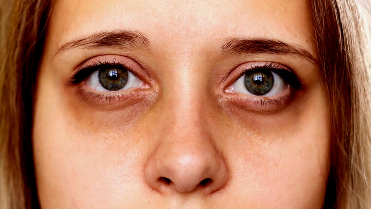 Causes Of Puffy Eyes And Home Remedies To Treat It