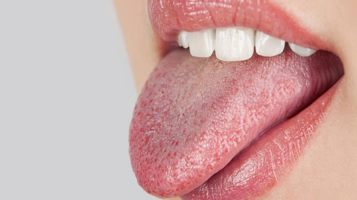 dry mouth in dengue