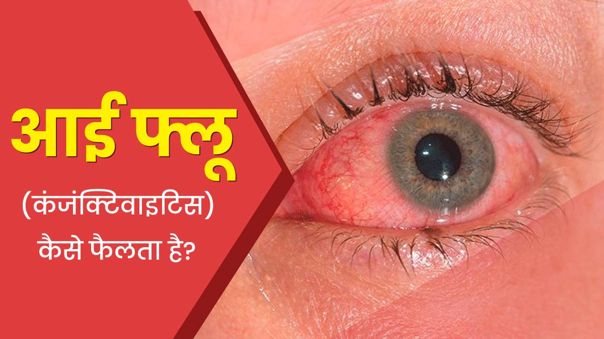 Eye Flu: आई फ्लू (कंजंक्टिवाइटिस) कैसे फैलता है? डॉक्टर से जानें 