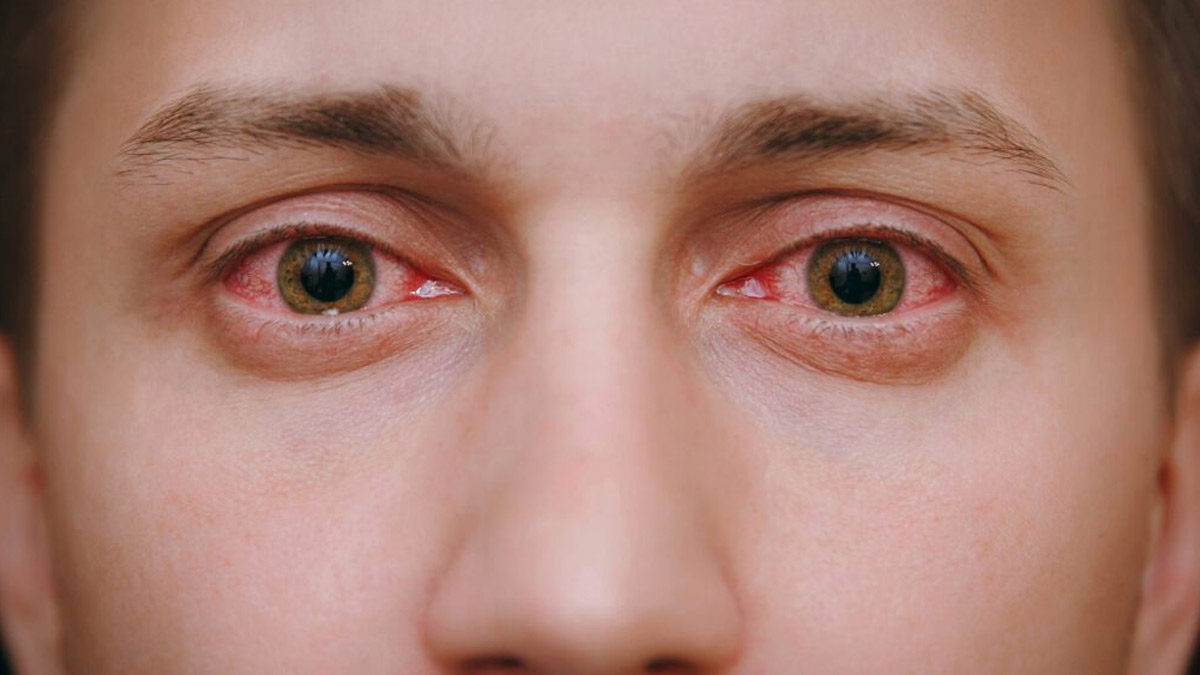 how eye flu spreads