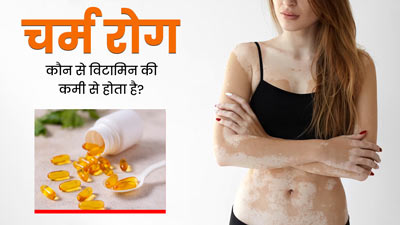 शरीर में इस विटामिन की कमी से हो सकता है चर्म रोग, जानें बचाव के टिप्स