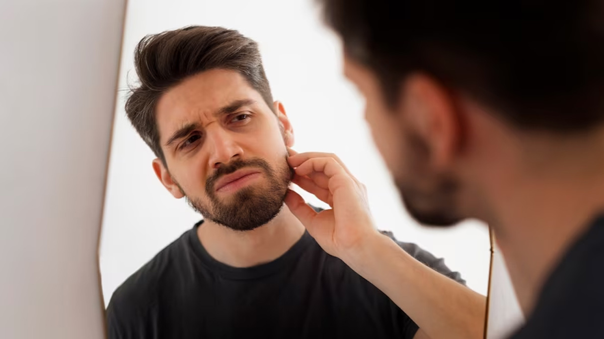 Beard Dandruff Heres How You Can Get Rid Of It Naturally Onlymyhealth 