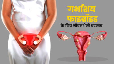 गर्भाशय फाइब्रॉइड (बच्चे दानी में गांठ) से बचाव के लिए अपनी लाइफस्टाइल में करें ये 5 बदलाव