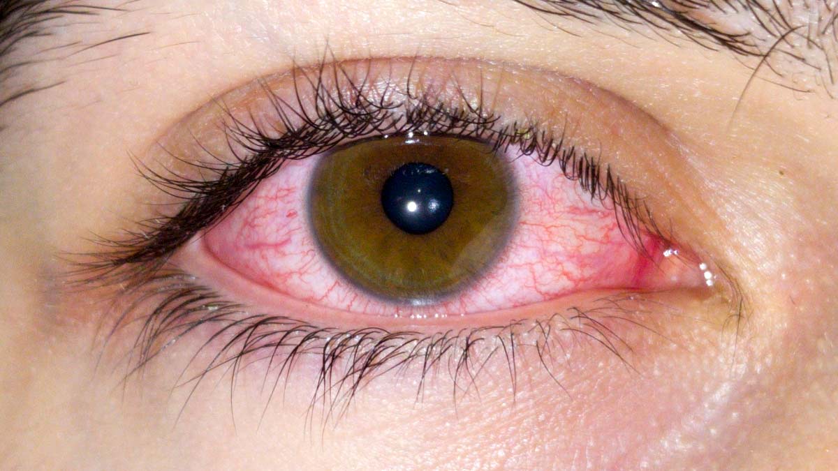 Eye Flu Treatment: आई फ्लू के इलाज के दौरान न करें ये 5 गलति‍यां, ठीक होने में लगेगा ज्यादा समय