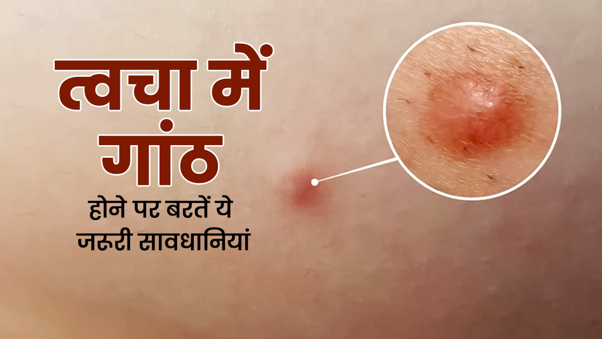 Skin Lump: त्वचा में गांठ होने पर बरतें जरूरी सावधान‍ियां, डॉक्‍टर से जानें इस दौरान क्या करें और क्या नहीं 