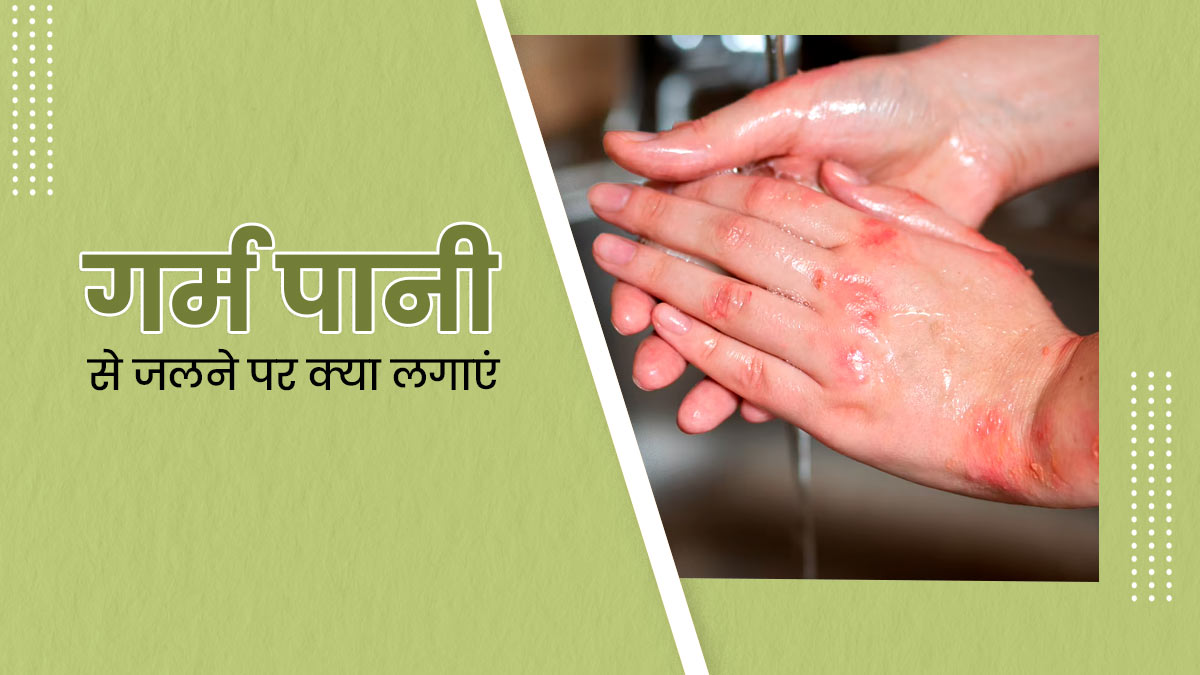 गर्म पानी से जलने पर ये 4 चीजें लगाएं, मिलेगी राहत
