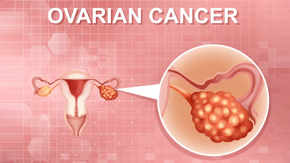 Ovarian-Cancer