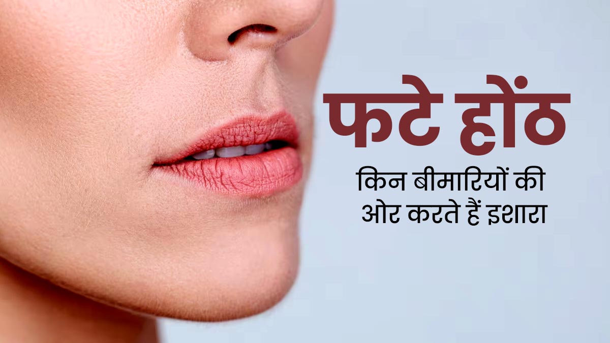 बार-बार होंठ फटना हो सकता है कई गंभीर बीमारियों का संकेत, डॉक्टर से जानें क्या है कारण