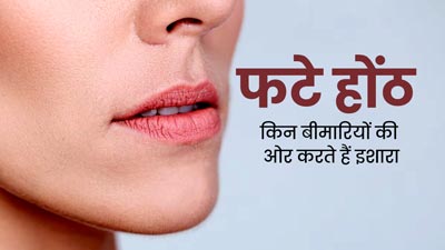 बार-बार होंठ फटना हो सकता है कई गंभीर बीमारियों का संकेत, डॉक्टर से जानें क्या है कारण