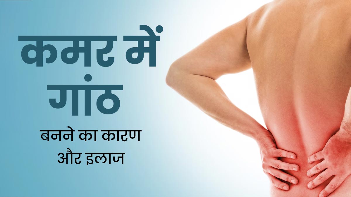 कमर में महसूस हो रही गांठ को न करें नजरअंदाज, डॉक्‍टर से जानें इसका कारण और इलाज