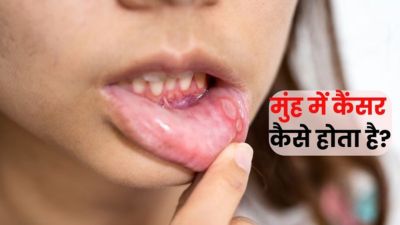 मुंह में कैंसर कैसे होता है? जानें इसके शुरुआती लक्षण और बचाव