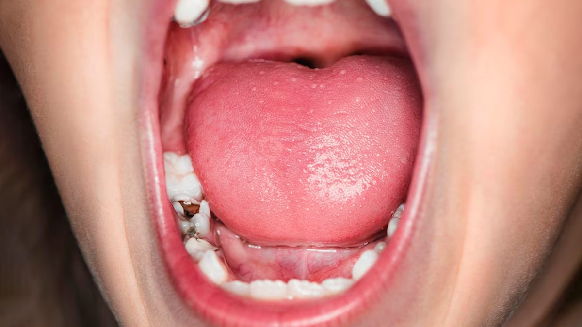Cavities
