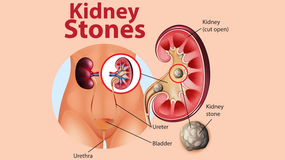 Kidney-Stones