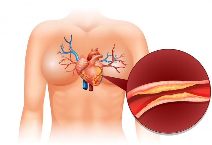 Reasons-for-High-Cholesterol