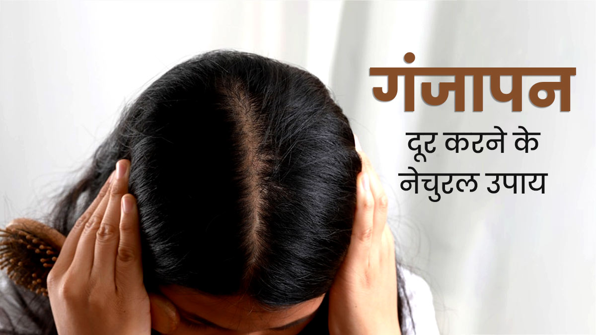 मह‍िलाओं में गंजापन कम करने के लिए आजमाएं एक्‍सपर्ट के बताए ये 5 नेचुरल उपाय