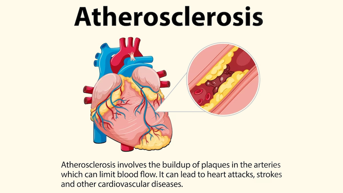 Atherosclerotic