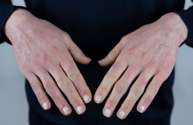 Causes Of Low Hemoglobin In Males in hindi