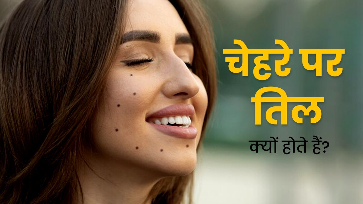 चेहरे पर तिल क्यों होते हैं? डॉक्टर से जानें इसके कारण और बचाव के टिप्स