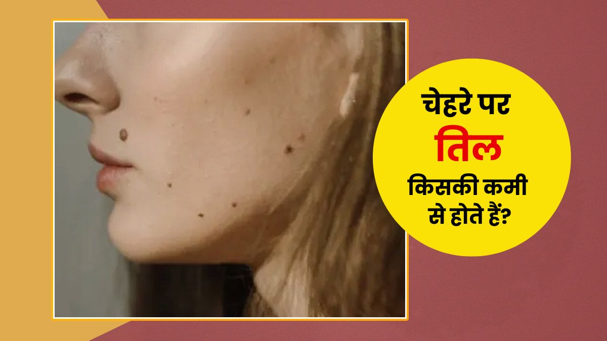 चेहरे पर तिल किसकी कमी से होते हैं? डॉक्टर से जानें कारण