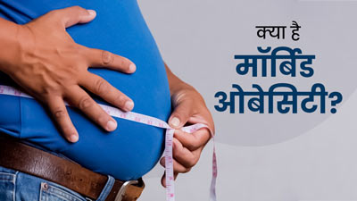 35 से ज्‍यादा बीएमआई देता है मॉर्बिड ओबेसिटी का संकेत, जानें इस कंडीशन का कारण और इलाज