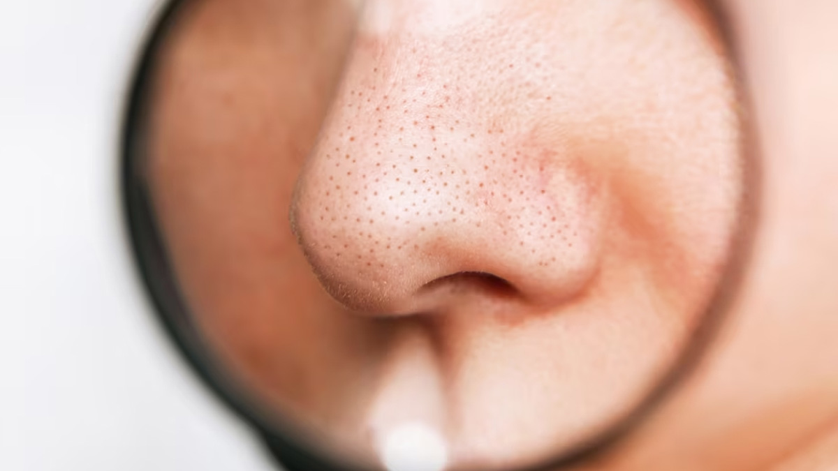 Causes-of-Blackheads