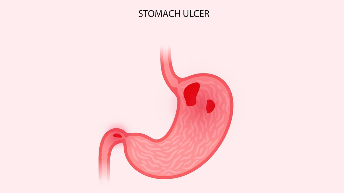 Causes-of-Stomach-Ulcers