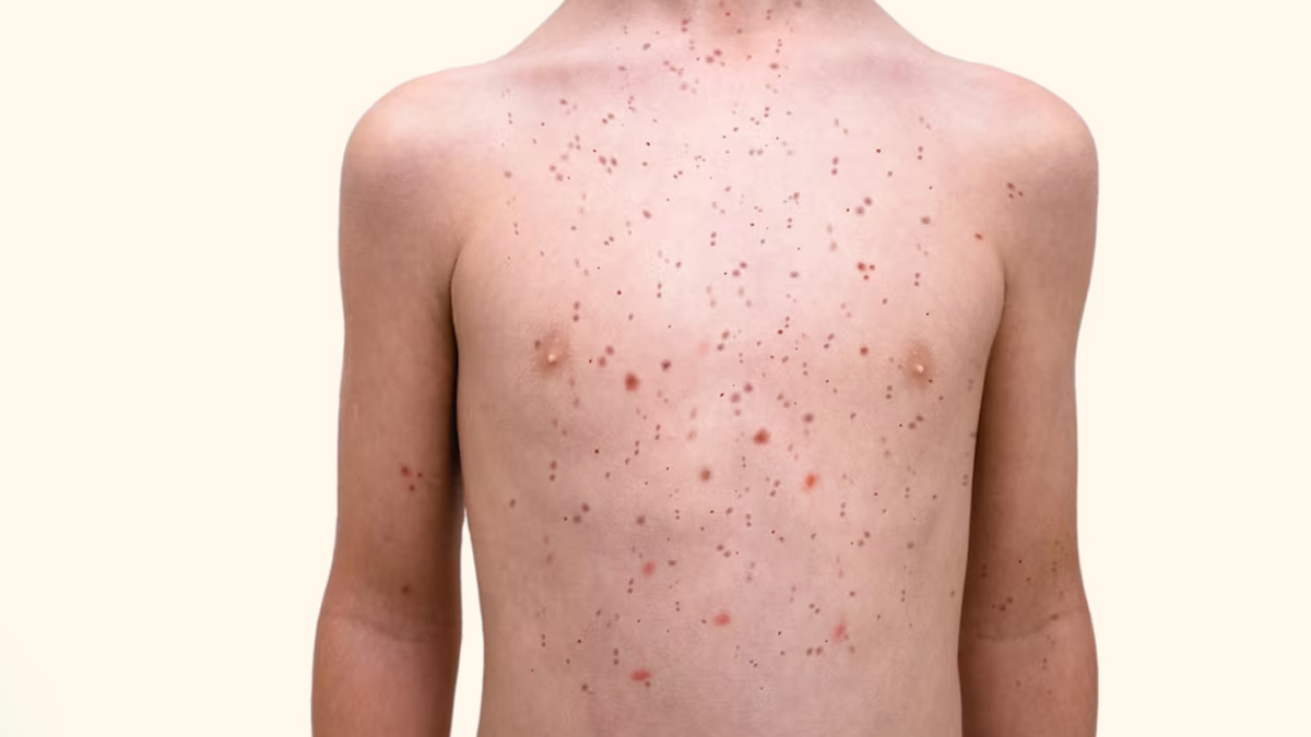 Major-Epidemic-Diseases-Measles