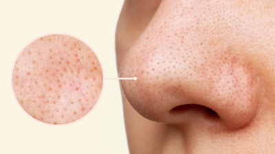 Natural Remedies For Quick Blackhead Removal