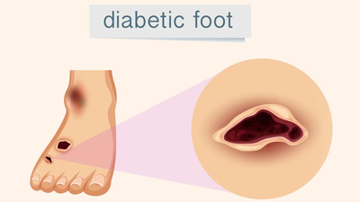 It Is Important To Take Care Of Your Feet If You Are Diabetic, Here’s ...