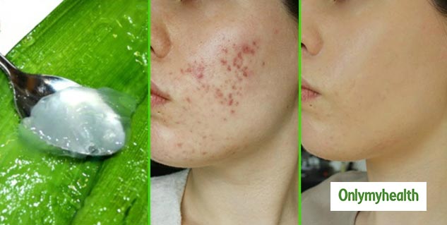 Health Benefits of Aloe Vera in Winters