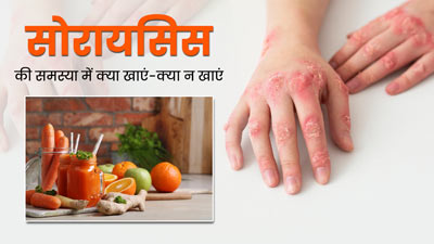 सोरायसिस होने पर क्या खाना चाहिए और क्या नहीं? जानें एक्सपर्स से