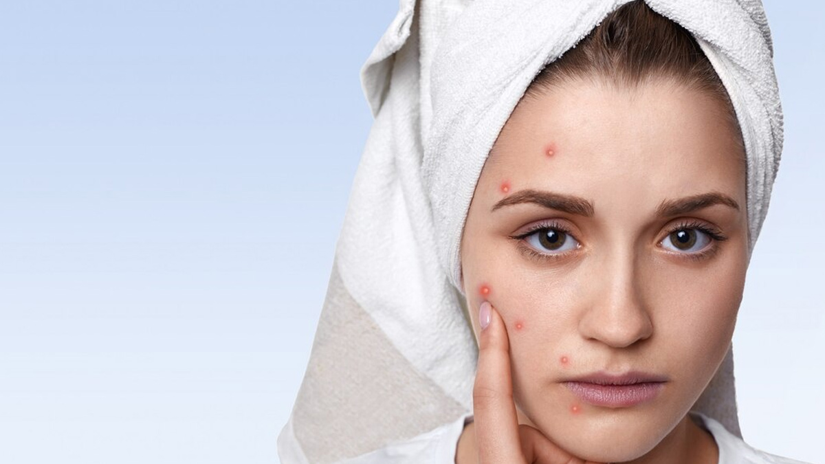 pimple