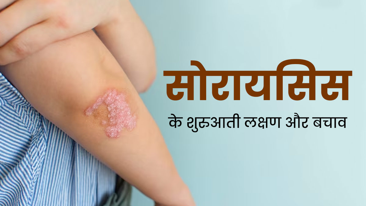 सोरायसिस होने पर नजर आते हैं ये 5 शुरुआती लक्षण, ऐसे करें इससे बचाव